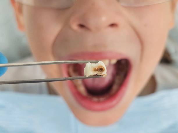 Best Emergency Treatment for Dental Infections or Abscesses in Leith Hatfield, PA